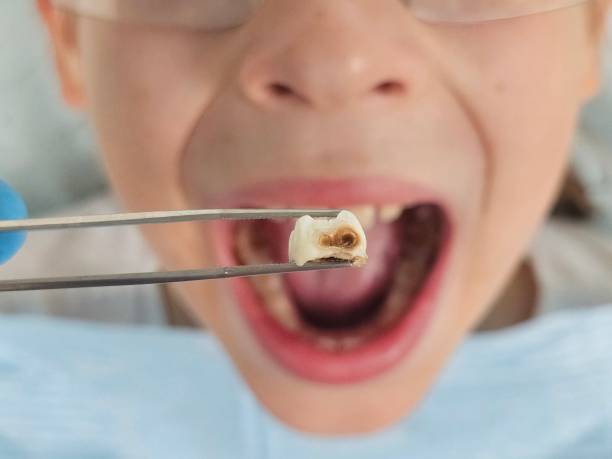 Best Emergency Dental Care for Abscessed Tooth in Antelope, CA